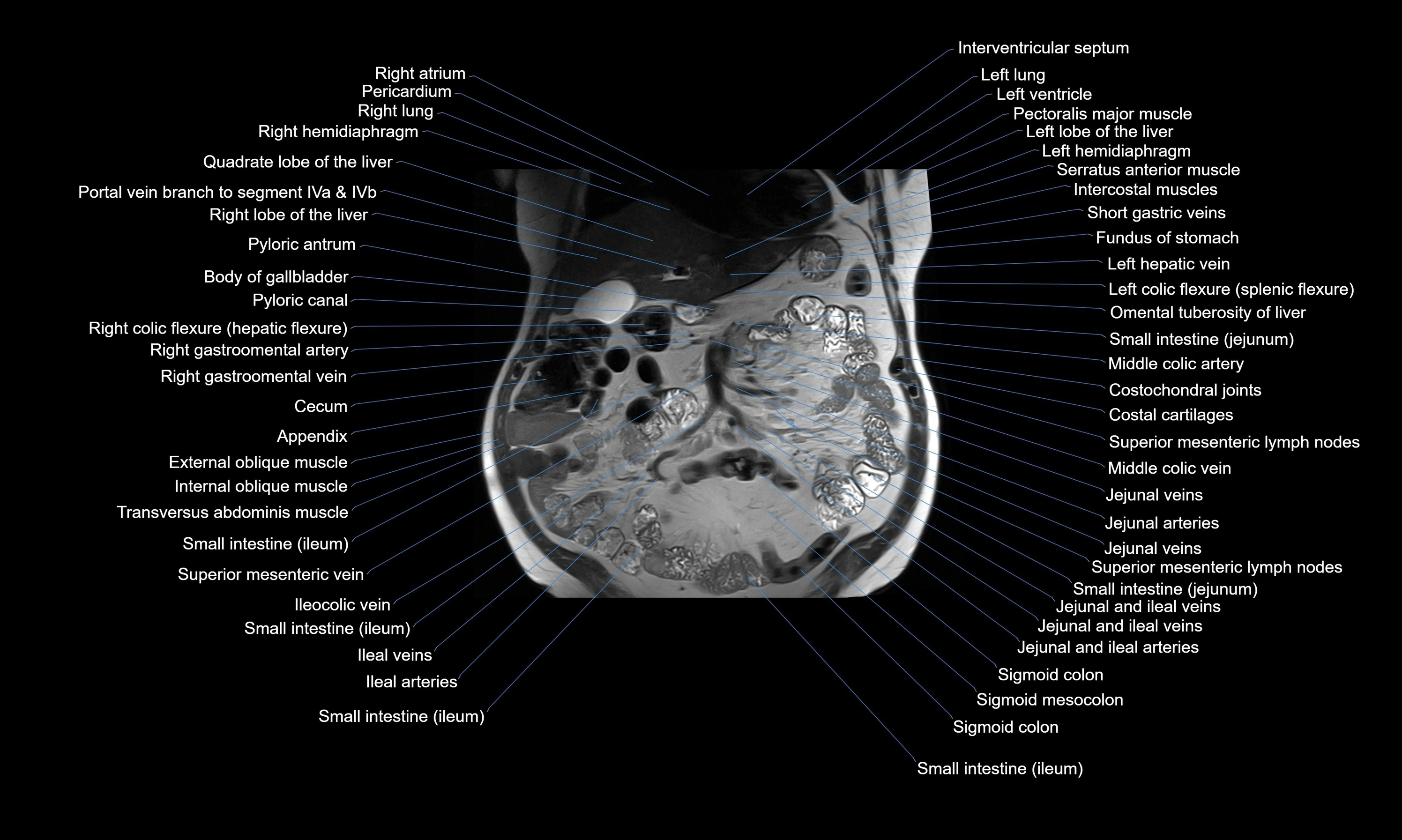 MRI Abdomen axial cross sectional anatomy radiology  image-img-00001-00022.webp